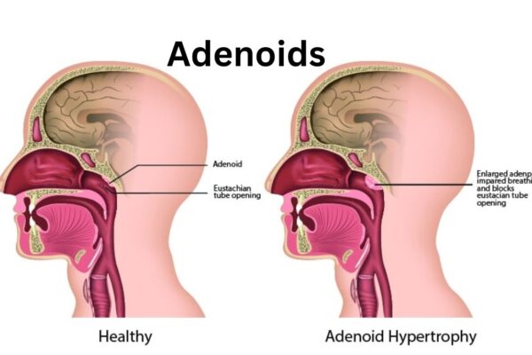 Adenoids