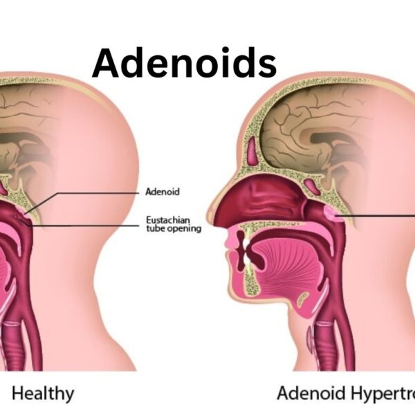 Adenoids