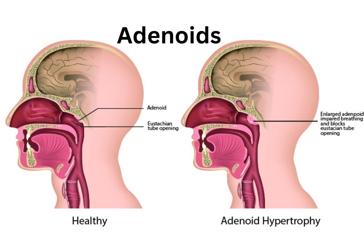 Adenoids